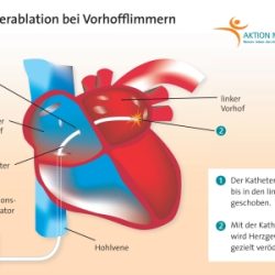 Bei Vorhofflimmern hilft die Ablation